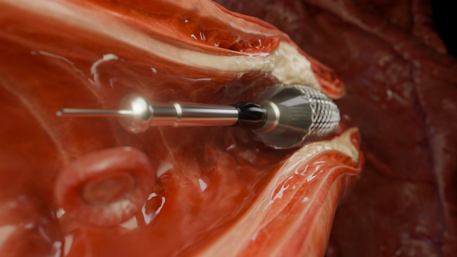 The device and its guidewire pushing through the narrowed vessel