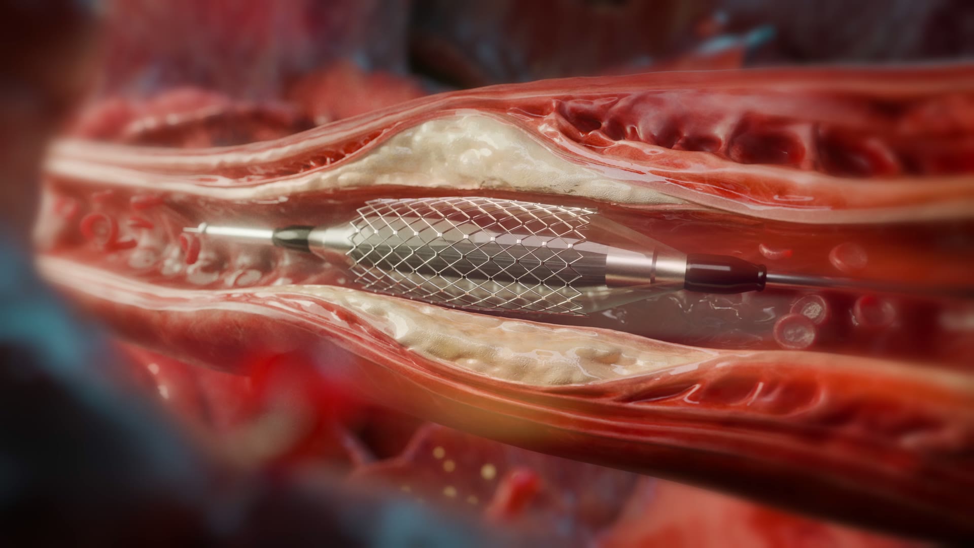 The stent retriever opened inside the cut-away vessel