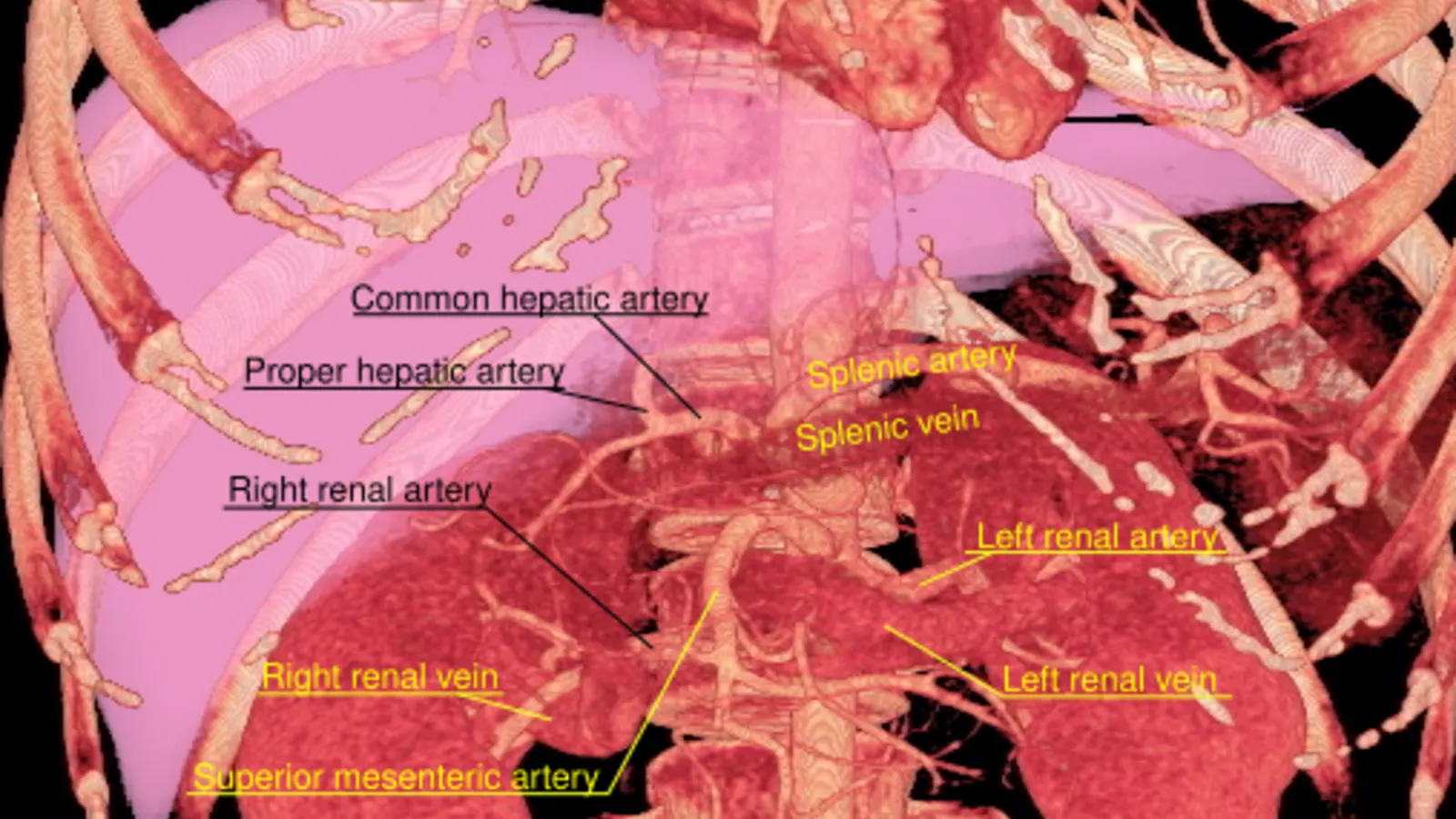 3D rendered CT of abdominal aortic branches and kidneys